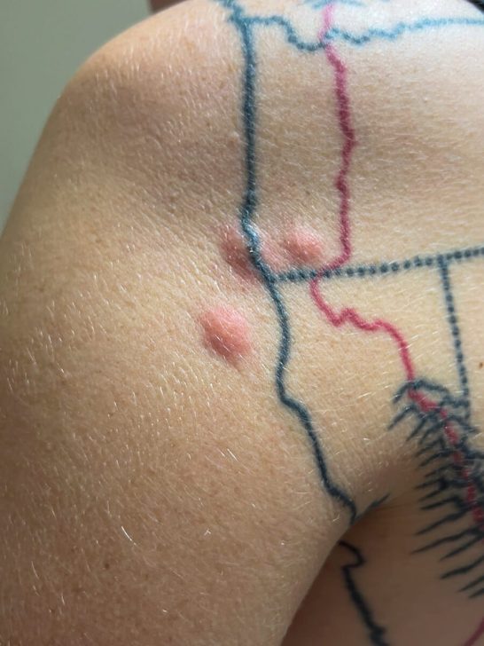 Bed bug bites on my shoulder after a night in a municipal albergue.