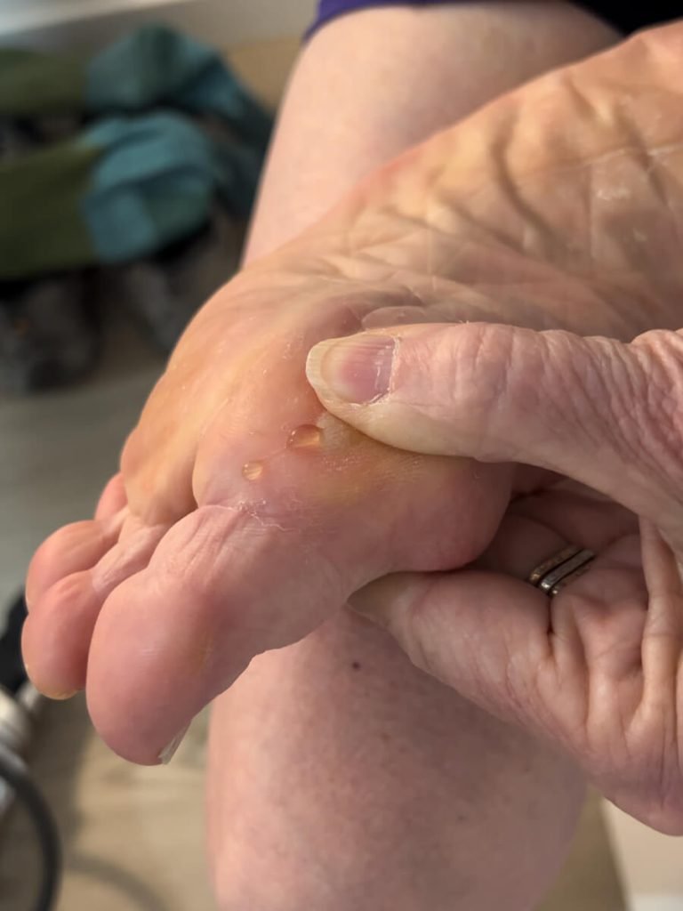 Showing a blister has formed on the ball of my Mom's foot on the Camino.