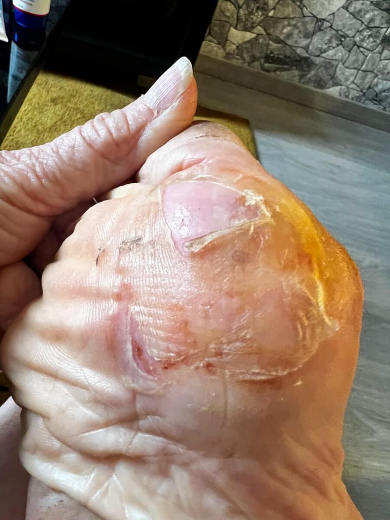 My Mom's blisters airing out after pharmacy treatment, allowing the skin to heal.
